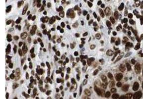 Immunohistochemistry of HDAC1 polyclonal antibody  shows strong nuclear staining of tumor cells in human lung tissue. (HDAC1 antibody  (AA 466-482))