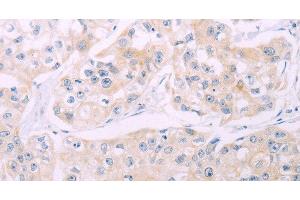 Immunohistochemistry of paraffin-embedded Human breast cancer tissue using ADCY7 Polyclonal Antibody at dilution 1:60