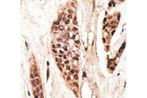 IHC analysis of FFPE human breast carcinoma tissue stained with the TAP1 antibody (TAP1 antibody  (AA 765-794))