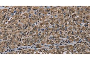 Immunohistochemistry of paraffin-embedded Human thyroid cancer tissue using NLRP6 Polyclonal Antibody at dilution 1:50 (NLRP6 antibody)