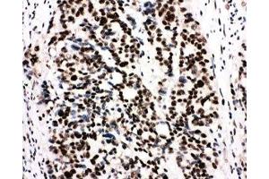 IHC-P: Ku80 antibody testing of human breast cancer tissue (XRCC5 antibody  (C-Term))