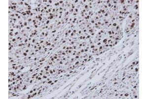 IHC-P Image Immunohistochemical analysis of paraffin-embedded U87 xenograft, using RecQ1, antibody at 1:100 dilution. (RecQ Protein-Like (DNA Helicase Q1-Like) (RECQL) (C-Term) antibody)