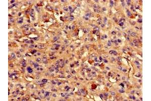 Immunohistochemistry of paraffin-embedded human melanoma using ABIN7144568 at dilution of 1:100 (ARAP3 antibody  (AA 163-320))
