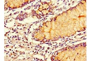 Immunohistochemistry of paraffin-embedded human colon cancer using ABIN7170420 at dilution of 1:100 (SMOC1 antibody  (AA 277-382))