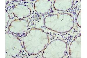 Immunohistochemistry of paraffin-embedded human colon cancer using ABIN7172096 at dilution of 1:100 (THBS3 antibody  (AA 787-956))
