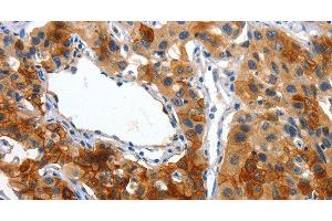 Immunohistochemistry of paraffin-embedded Human lung cancer using Placental Alkaline Phosphatase Polyclonal Antibody at dilution of 1:50 (PLAP antibody)