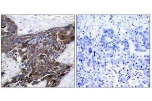 Immunohistochemical analysis of paraffin-embedded human breast carcinoma tissue using Connexin 43(Phospho-Ser367) Antibody(left) or the same antibody preincubated with blocking peptide(right). (Connexin 43/GJA1 antibody  (pSer368))