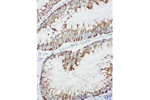 Anti-MEKK1 antibody, IHC(P) IHC(P): Human Intestinal Cancer Tissue (MAP3K1 antibody  (C-Term))