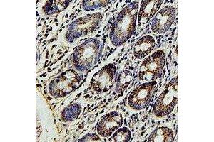 Immunohistochemical analysis of FBL5 staining in human colon cancer formalin fixed paraffin embedded tissue section. (FBXL4 antibody)