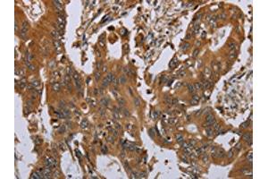 The image on the left is immunohistochemistry of paraffin-embedded Human colon cancer tissue using ABIN7191746(OSM Antibody) at dilution 1/40, on the right is treated with synthetic peptide. (Oncostatin M antibody)