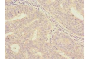 Immunohistochemistry of paraffin-embedded human endometrial cancer using ABIN7157058 at dilution of 1:100 (ISCU antibody  (AA 1-167))