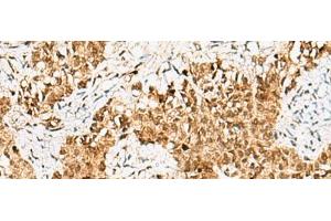 Immunohistochemistry of paraffin-embedded Human ovarian cancer tissue using CRCP Polyclonal Antibody at dilution of 1:65(x200) (CRCP antibody)