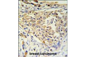 ADFP Antibody IHC analysis in formalin fixed and paraffin embedded breast carcinoma followed by peroxidase conjugation of the secondary antibody and DAB staining. (ADRP antibody  (AA 186-214))