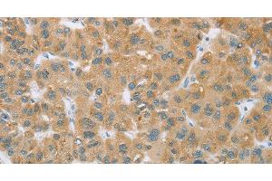 Immunohistochemistry of paraffin-embedded Human liver cancer tissue using CYP2C9 Polyclonal Antibody at dilution 1:35 (CYP2C9 antibody)