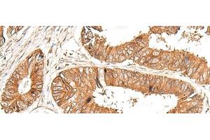 Immunohistochemistry of paraffin-embedded Human colorectal cancer tissue using GFI1 Polyclonal Antibody at dilution of 1:100(x200)