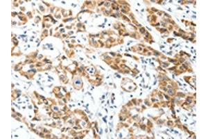 The image on the left is immunohistochemistry of paraffin-embedded Human lung cancer tissue using ABIN7130157(MAP3K14 Antibody) at dilution 1/30, on the right is treated with fusion protein. (MAP3K14 antibody)