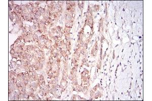 Immunohistochemical analysis of paraffin-embedded liver cancer tissues using MSTN mouse mAb with DAB staining. (MSTN antibody  (AA 24-266))