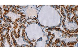 Immunohistochemistry of paraffin-embedded Human thyroid cancer tissue using CMC4 Polyclonal Antibody at dilution 1:55 (CMC4 antibody)