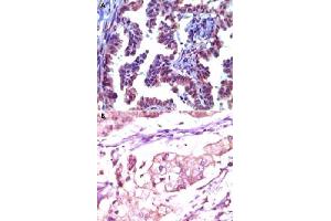Immunohistochemical analysis of paraffin-embedded metastatic adenocarcinoma (A) showing cytoplasmic localization, human stomach adenocarcinoma (B) showing cytoplasmic localization, using TRIM5 monoclonal antibody, clone 3B11H2 .