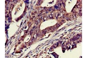 Immunohistochemistry of paraffin-embedded human colon cancer using ABIN7150733 at dilution of 1:100