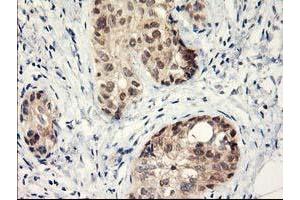 Immunohistochemical staining of paraffin-embedded Adenocarcinoma of Human breast tissue using anti-LPL mouse monoclonal antibody. (Lipoprotein Lipase antibody  (AA 28-475))