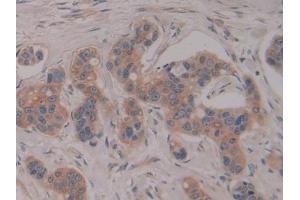 Detection of PSG1 in Human Breast cancer Tissue using Polyclonal Antibody to Pregnancy Specific Beta-1-Glycoprotein 1 (PSG1) (PSG1 antibody  (AA 202-401))