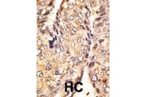 Formalin-fixed and paraffin-embedded human cancer tissue reacted with the primary antibody, which was peroxidase-conjugated to the secondary antibody, followed by DAB staining. (GDF10 antibody  (N-Term))