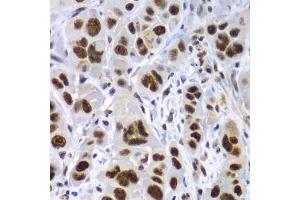 Immunohistochemistry of paraffin-embedded human gastric cancer using SF3B2 antibody (ABIN5973482) at dilution of 1/100 (40x lens). (SF3B2 antibody)