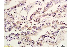 Formalin-fixed and paraffin embedded human colon cancer labeled with Anti Amphiregulin Polyclonal Antibody, Unconjugated  at 1:600 followed by conjugation to the secondary antibody and DAB staining