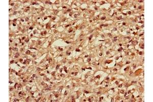 Immunohistochemistry of paraffin-embedded human melanoma using ABIN7159613 at dilution of 1:100