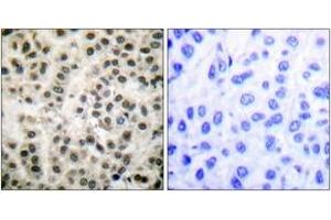 Immunohistochemistry analysis of paraffin-embedded human breast carcinoma tissue, using MEF2A (Ab-408) Antibody. (MEF2A antibody  (AA 374-423))