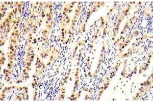 Immunohistochemistry (IHC) analyzes of LKB1 antibody in paraffin-embedded human lung carcinoma tissue. (LKB1 antibody)