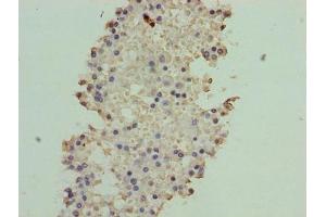 Immunohistochemistry of paraffin-embedded human breast cancer using ABIN7144801 at dilution of 1:100 (ATXN7L1 antibody  (AA 1-146))