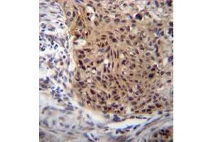Formalin fixed and paraffin embedded human esophageal carcinoma reacted with EXTL3 Antibody (N-term) followed by peroxidase conjugation of the secondary antibody and DAB staining.
