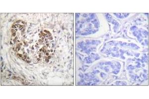 Immunohistochemistry analysis of paraffin-embedded human breast carcinoma tissue, using p53 (Ab-20) Antibody. (p53 antibody  (AA 10-59))