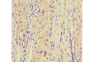 Immunohistochemistry of paraffin-embedded human liver cancer using ABIN7145840 at dilution of 1:100 (KCTD16 antibody  (AA 201-428))