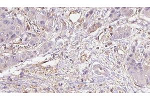 ABIN6273935 at 1/100 staining Human liver cancer tissue by IHC-P. (GPR39 antibody  (C-Term))