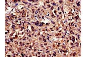 Immunocytochemistry analysis of human melanoma using ABIN7174228 at dilution of 1:100 (Ubiquilin 2 antibody  (AA 473-542))