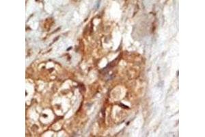 IHC analysis of FFPE human breast carcinoma tissue stained with the NIK antibody (MAP3K14 antibody  (AA 119-148))