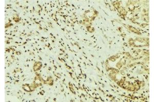 ABIN6269141 at 1/100 staining Human breast cancer tissue by IHC-P. (Src antibody  (N-Term))