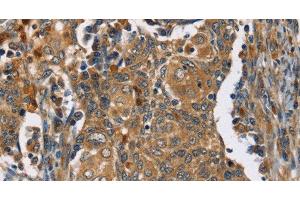 Immunohistochemistry of paraffin-embedded Human cervical cancer tissue using TAC1 Polyclonal Antibody at dilution 1:25 (TAC1 antibody)