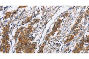 Immunohistochemistry of paraffin-embedded Human gasrtic cancer tissue using NCAPD3 Polyclonal Antibody at dilution 1:50 (NCAPD3 antibody)