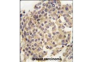 Forlin-fixed and paraffin-embedded hun breast carcino tissue reacted with P2K1 Antibody  (ABIN1881525 and ABIN2842060) , which was peroxidase-conjugated to the secondary antibody, followed by DAB staining. (MEK1 antibody  (AA 270-299))