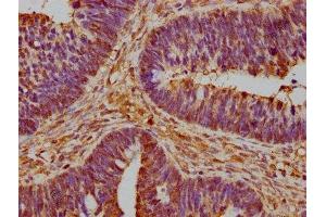 IHC image of ABIN7142780 diluted at 1:600 and staining in paraffin-embedded human ovarian cancer performed on a Leica BondTM system. (RPL26 antibody  (AA 48-143))