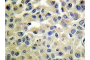 Immunohistochemistry analyzes of IKKα/β antibody in paraffin-embedded human breast carcinoma tissue.
