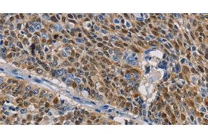 Immunohistochemistry of paraffin-embedded Human lung cancer tissue using GSTA2 Polyclonal Antibody at dilution 1:50 (GSTa2 antibody)
