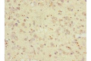 Immunohistochemistry of paraffin-embedded human glioma using ABIN7167625 at dilution of 1:100 (RGS antibody  (AA 230-350))