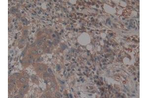 IHC-P analysis of Human Breast cancer Tissue, with DAB staining. (TEP1 antibody  (AA 2368-2627))