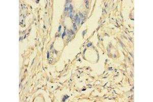Immunohistochemistry of paraffin-embedded human pancreatic cancer using ABIN7163295 at dilution of 1:100 (PIK3R5 antibody  (Regulatory Subunit 5))