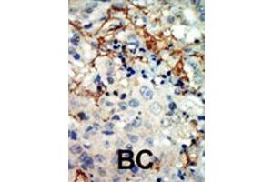 Formalin-fixed and paraffin-embedded human cancer tissue reacted with the primary antibody, which was peroxidase-conjugated to the secondary antibody, followed by AEC staining. (EPH Receptor A3 antibody  (N-Term))